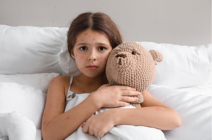 Детям Нормомед выписывают для лечения таких заболеваний как ветряная оспа и корь.