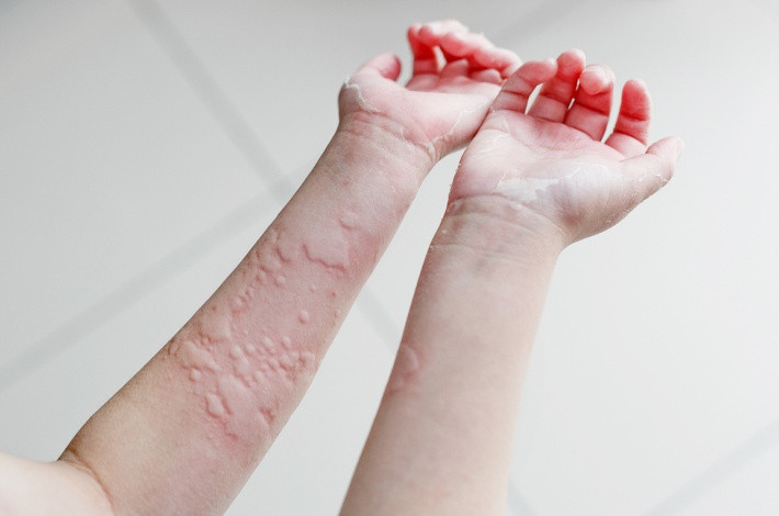 Хлоропирамин назначается при корапивнице.