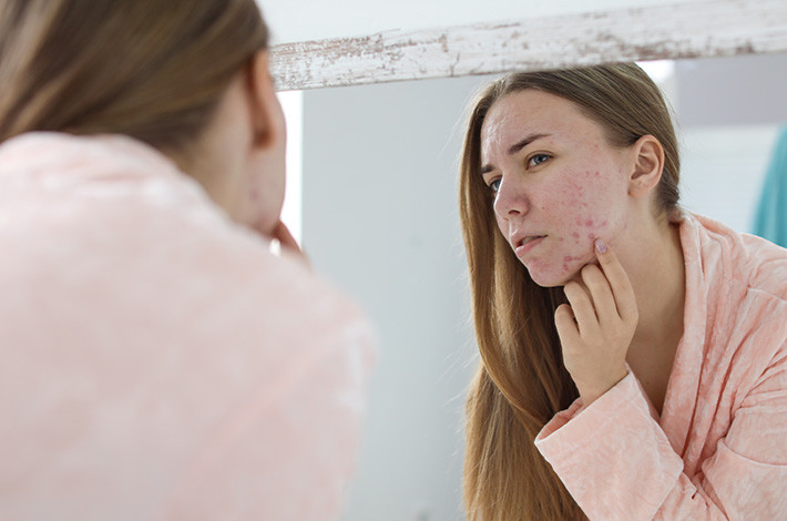 Азелик влияет на все факторы, приводящие к развитию угревой болезни.