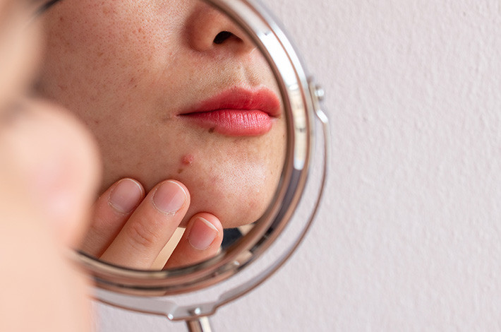 Азелаиновая кислота входит как в отечественные, так и в зарубежные руководства по лечению угревой болезни.