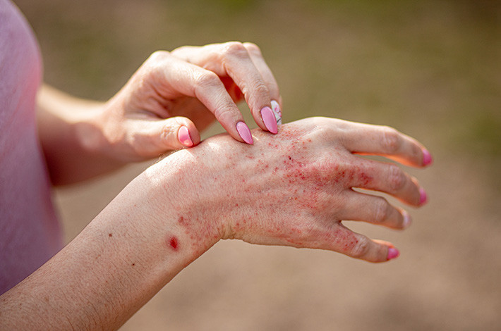 Микодерил назначают при различных кандидозах кожи.