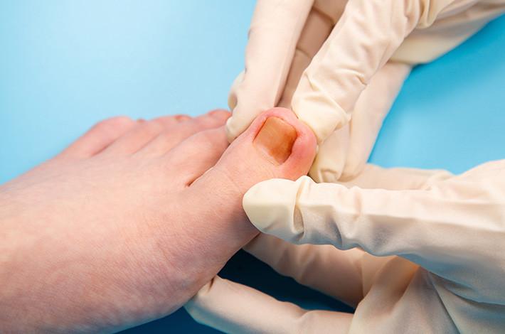 Микодерил помогает при лечении грибковых инфекций ногтей. 