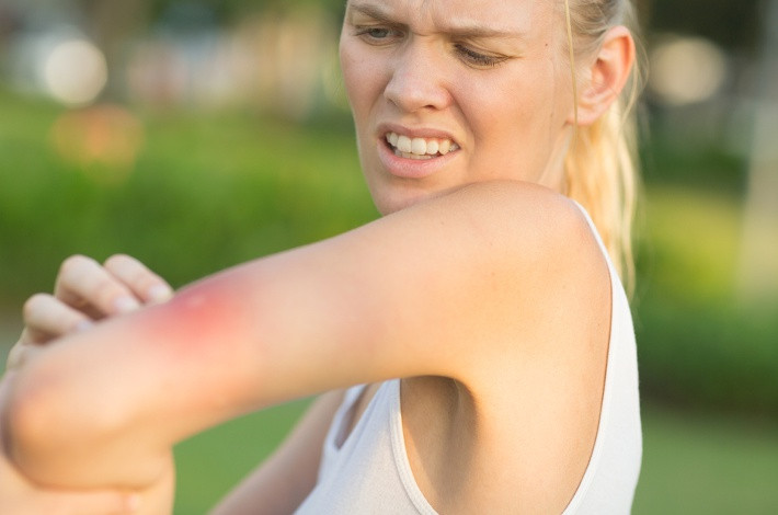 Хлоропирамин назначается при укусах насекомых.