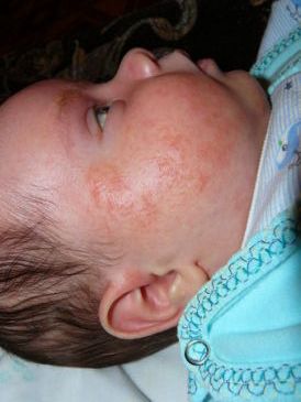 Сыпь на лице у месячного ребенка комаровский thumbnail